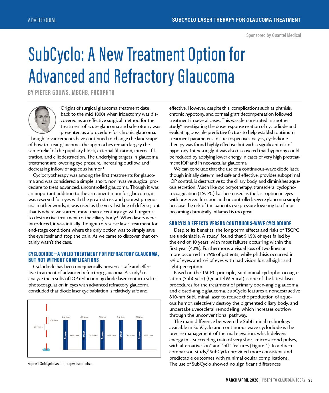 Subcyclo Laser Therapy for Glaucoma Treatment